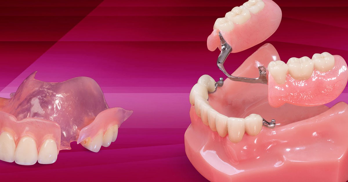 Partial Dentures Procedure Corpus Christi TX 78478